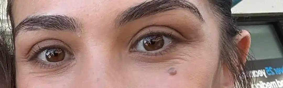 Göz Altı Kırışıklıklarıyla Mücadelede Etkili Yöntemler ve Cilt Bakım Rehberi