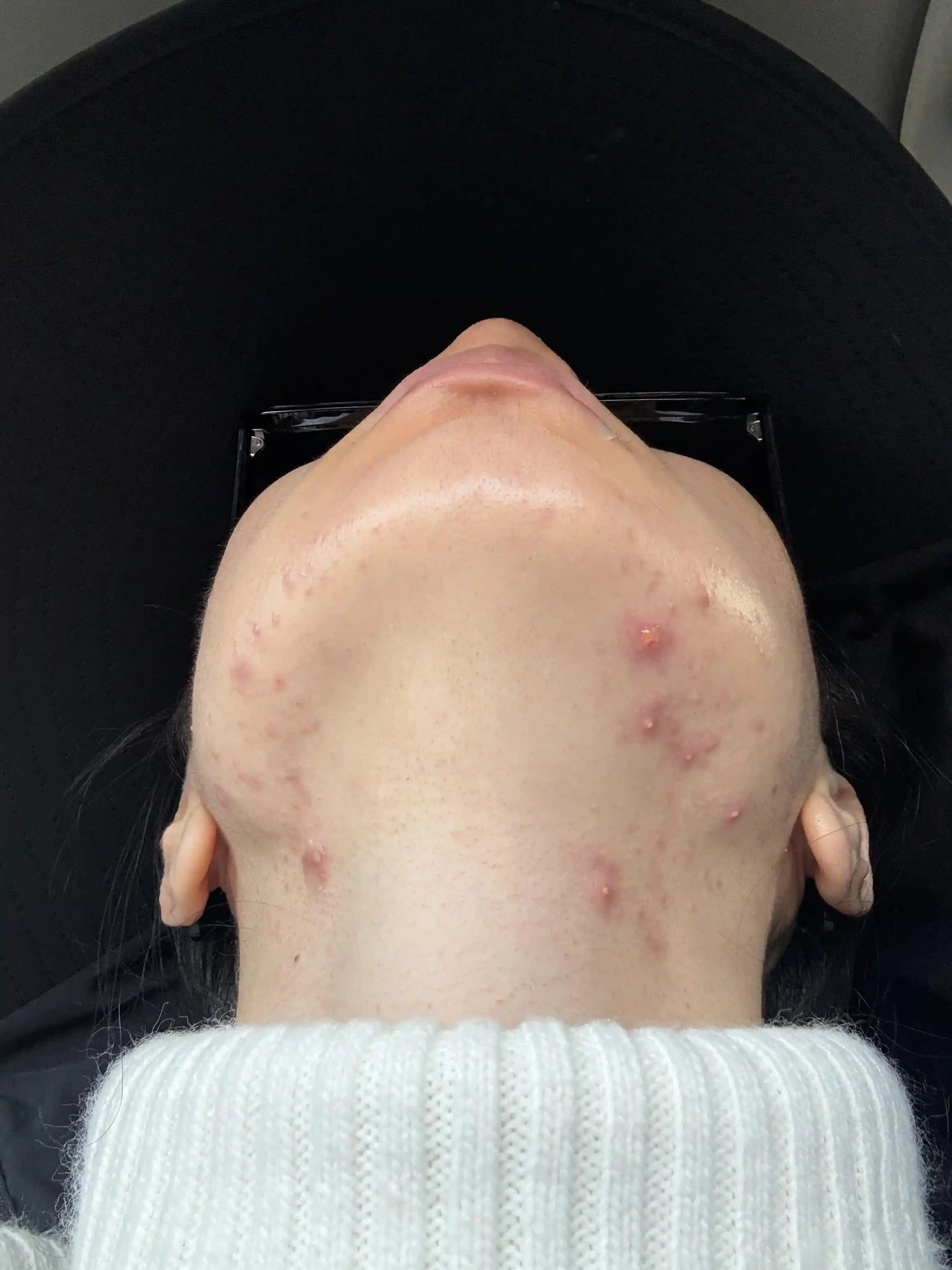 Hormonal Akne Tedavisinde 3 Yıllık Mücadele: Yöntemler, Zorluklar ve Hasta Deneyimleri