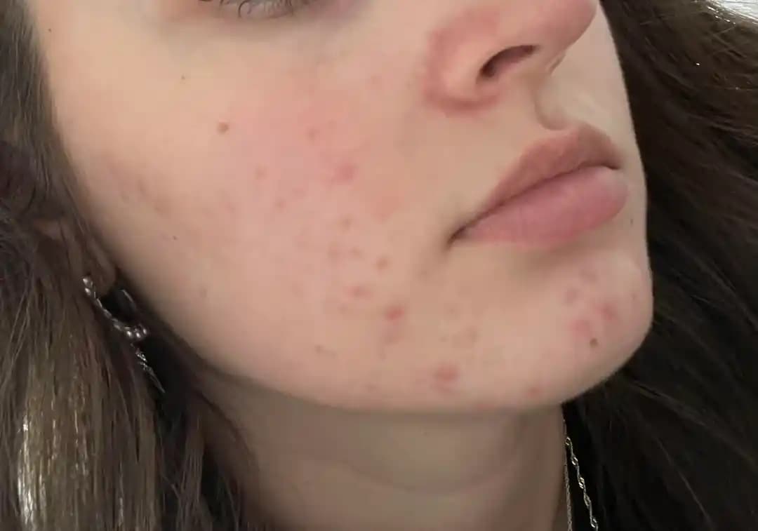 Hormonal Akne Tedavisinde Etkili Yöntemler ve Cilt Bakımı Yaklaşımları