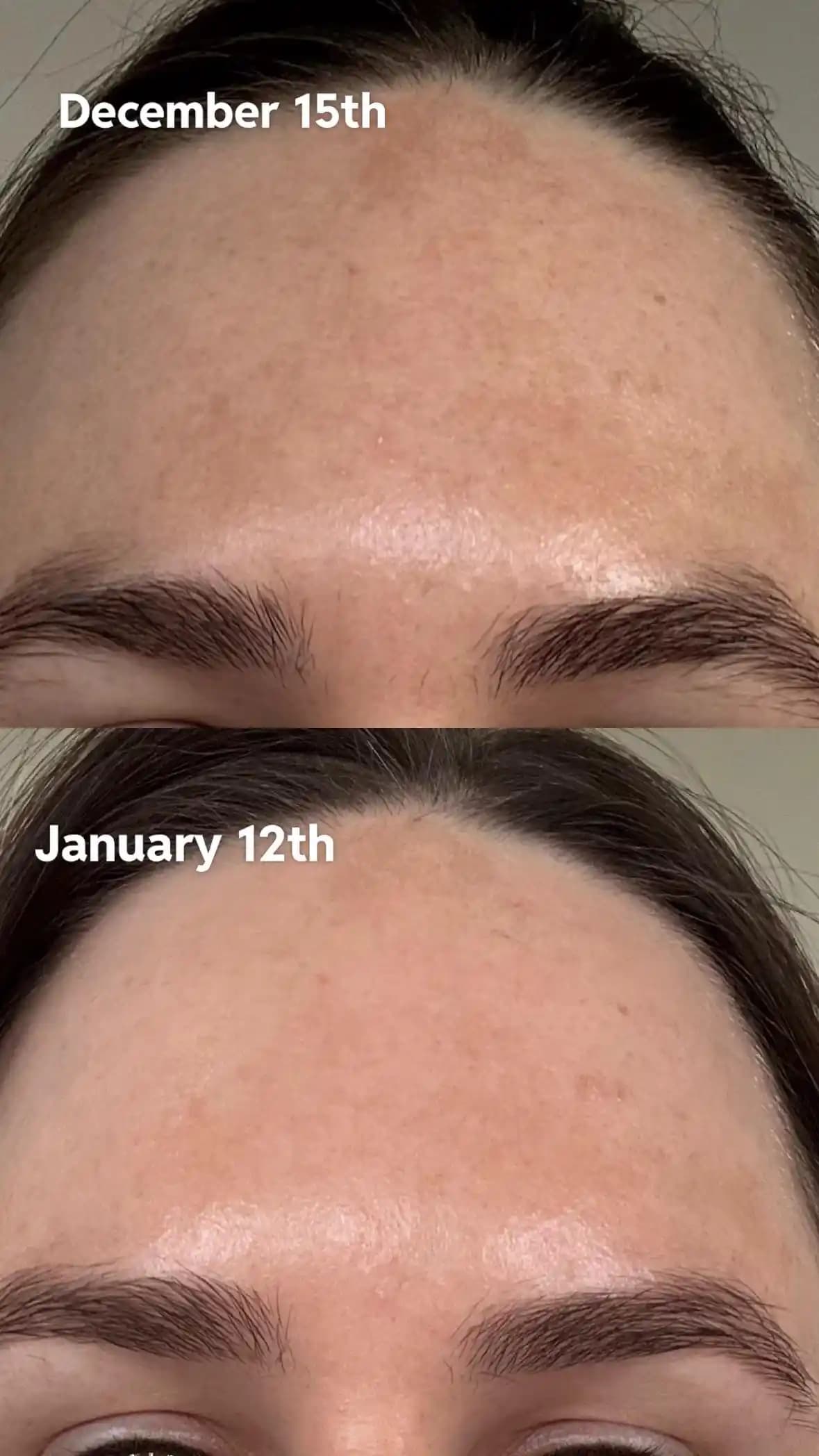 Hormonal Kontraseptiflere Bağlı Hiperpigmentasyon ve 1 Aylık Cilt Bakım Süreci Değerlendirmesi