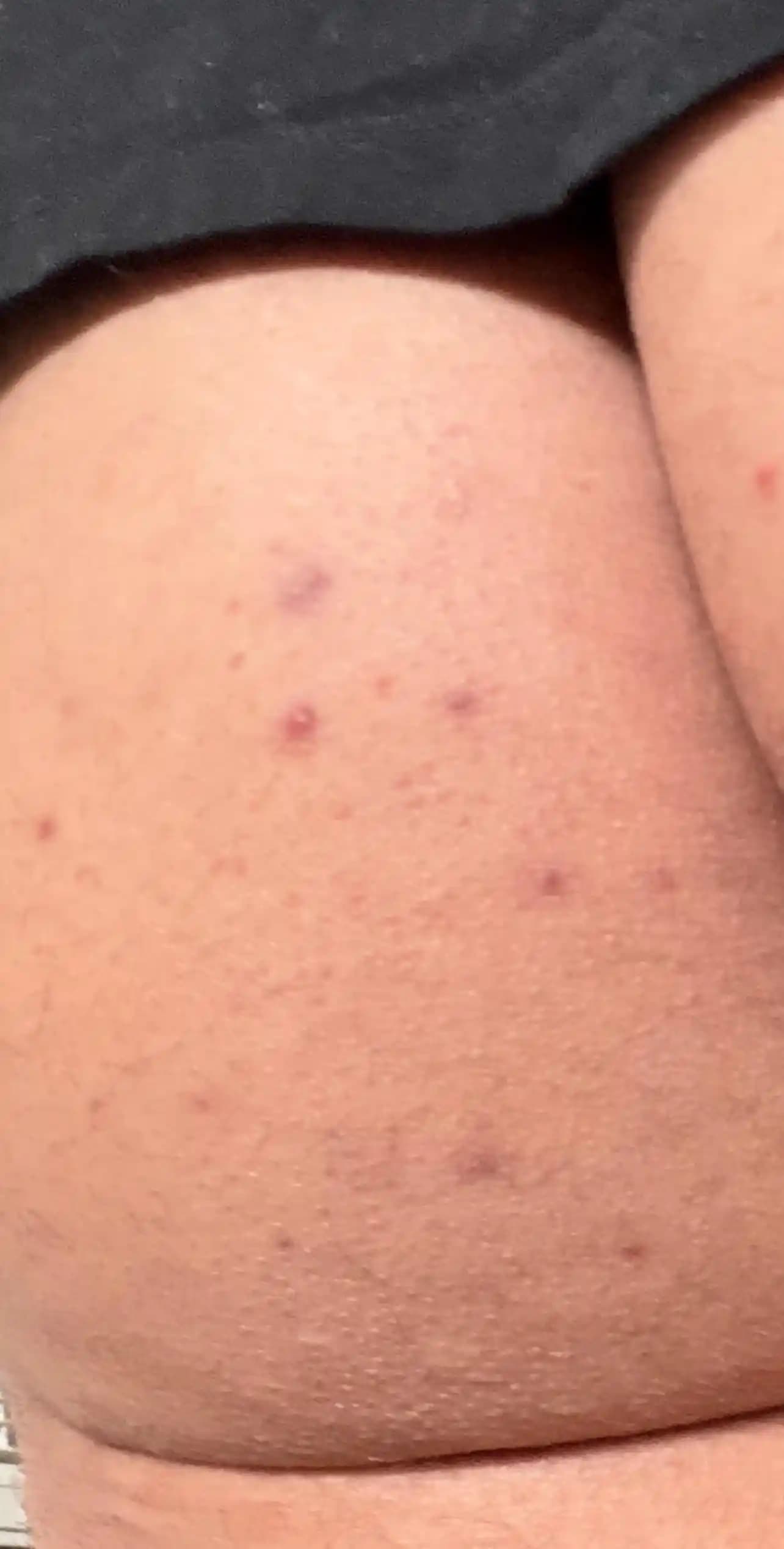 Kalça Bölgesinde Sivilce ve Akne Problemlerine Karşı Etkili Bakım ve Önleyici Yöntemler