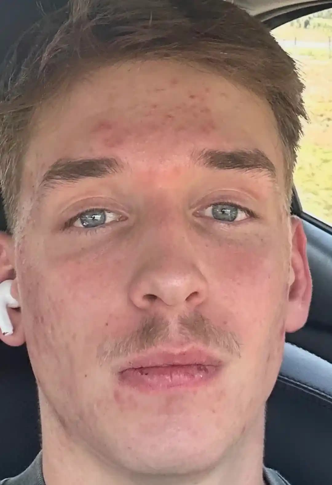 Minosiklin Tedavisinin Akne Üzerindeki Etkileri ve Tedavi Sonrası Durumlar