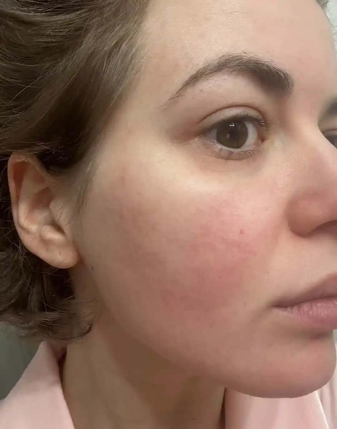 Moxi ve BBL Lazer Tedavisi: Cilt Yenilenmesi, Sonuçlar ve Tedavi Süreci Detayları