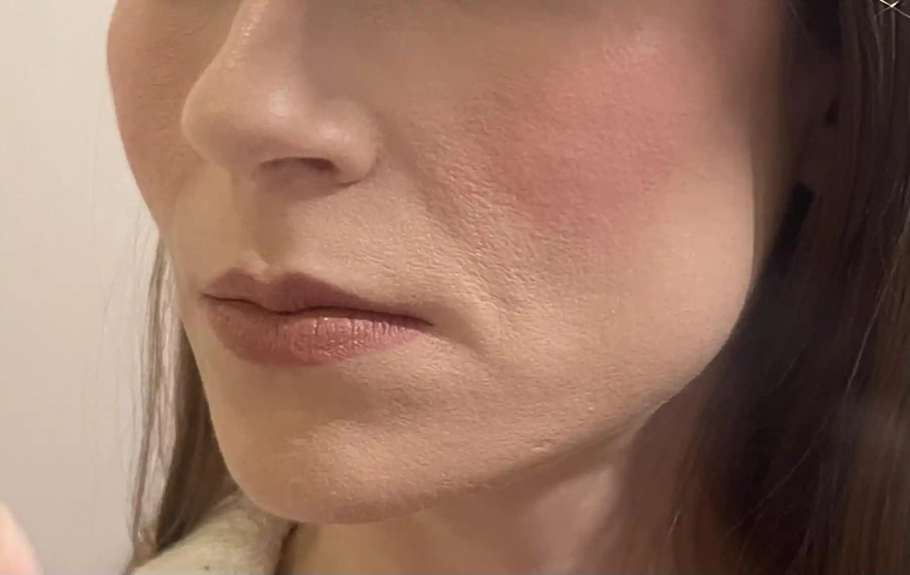 Nazolabial Sarkma ve Yaşlanma Belirtileri: Nedenleri, Tedavi Yöntemleri ve Bakım Önerileri