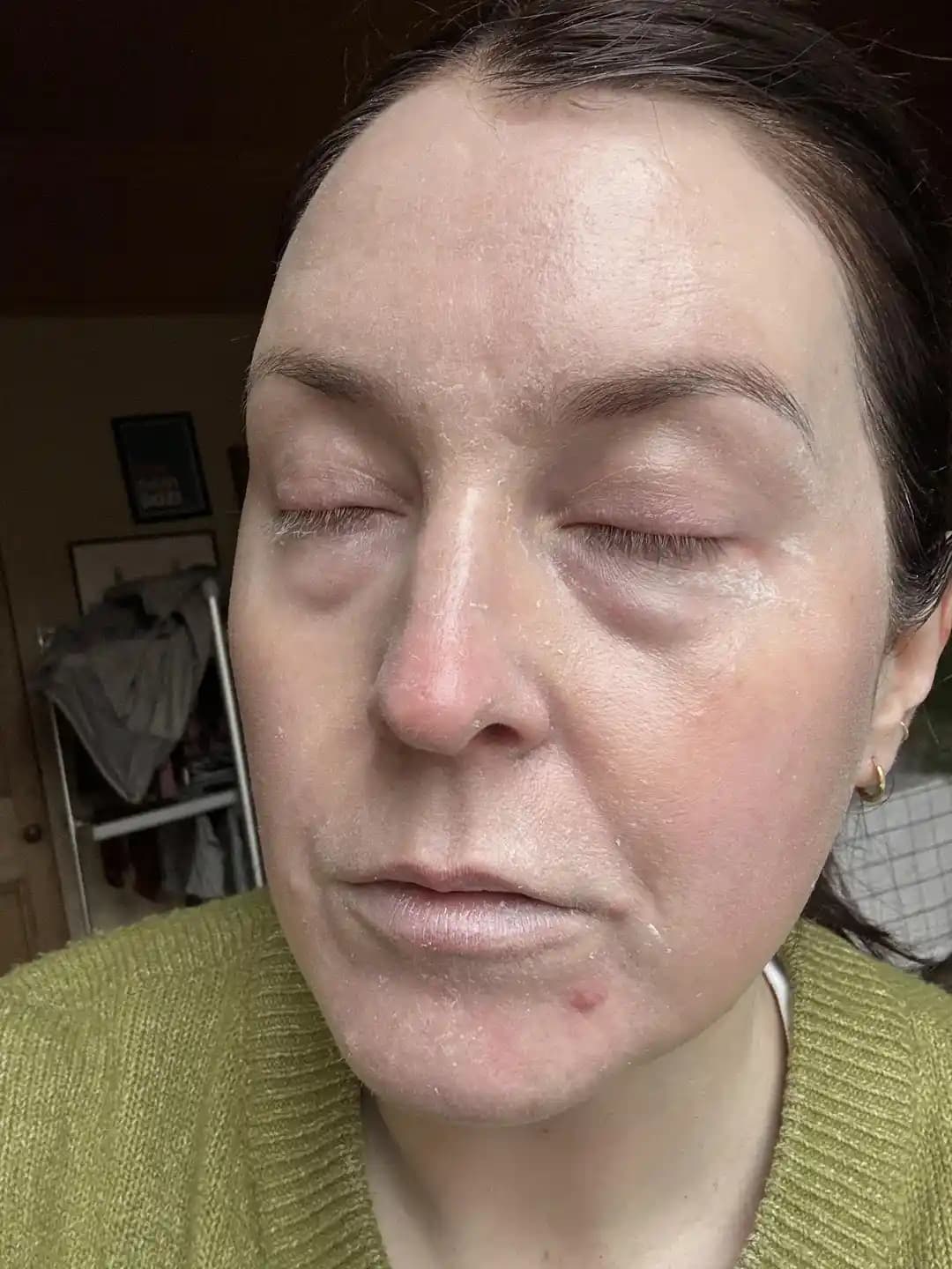 Ohave The First Laser Sunscreen ve Güneş Koruyucularda Beyaz Kalıntı ve Göz Yanması Sorunları