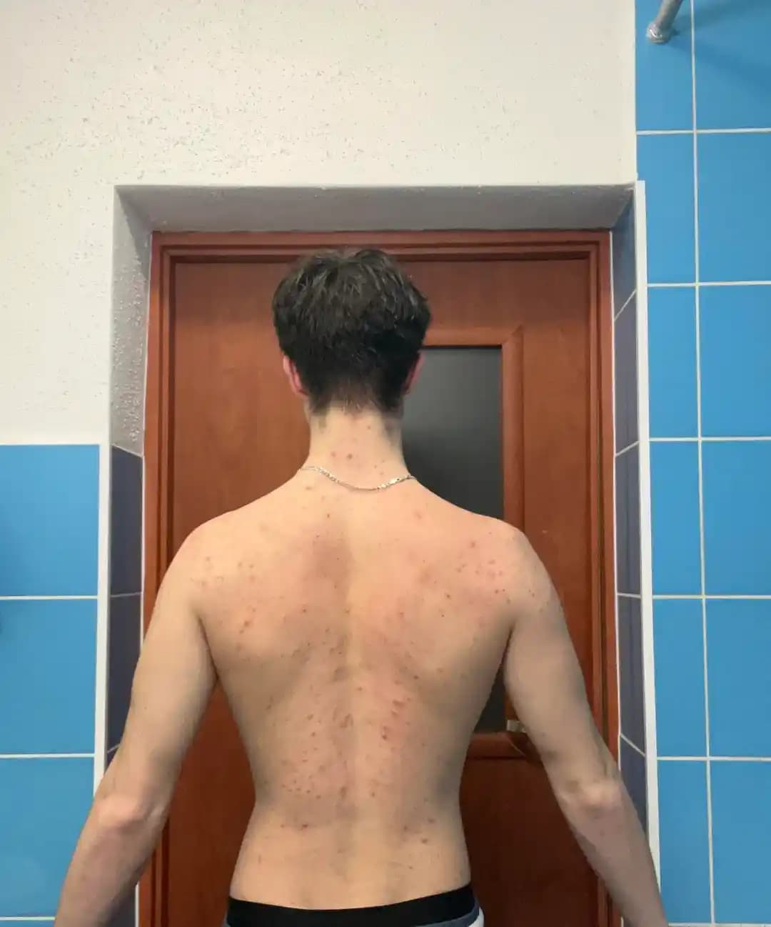 Sırt Aknesi Nedenleri, Önlemleri ve Etkili Tedavi Yöntemleri Hakkında Bilgi