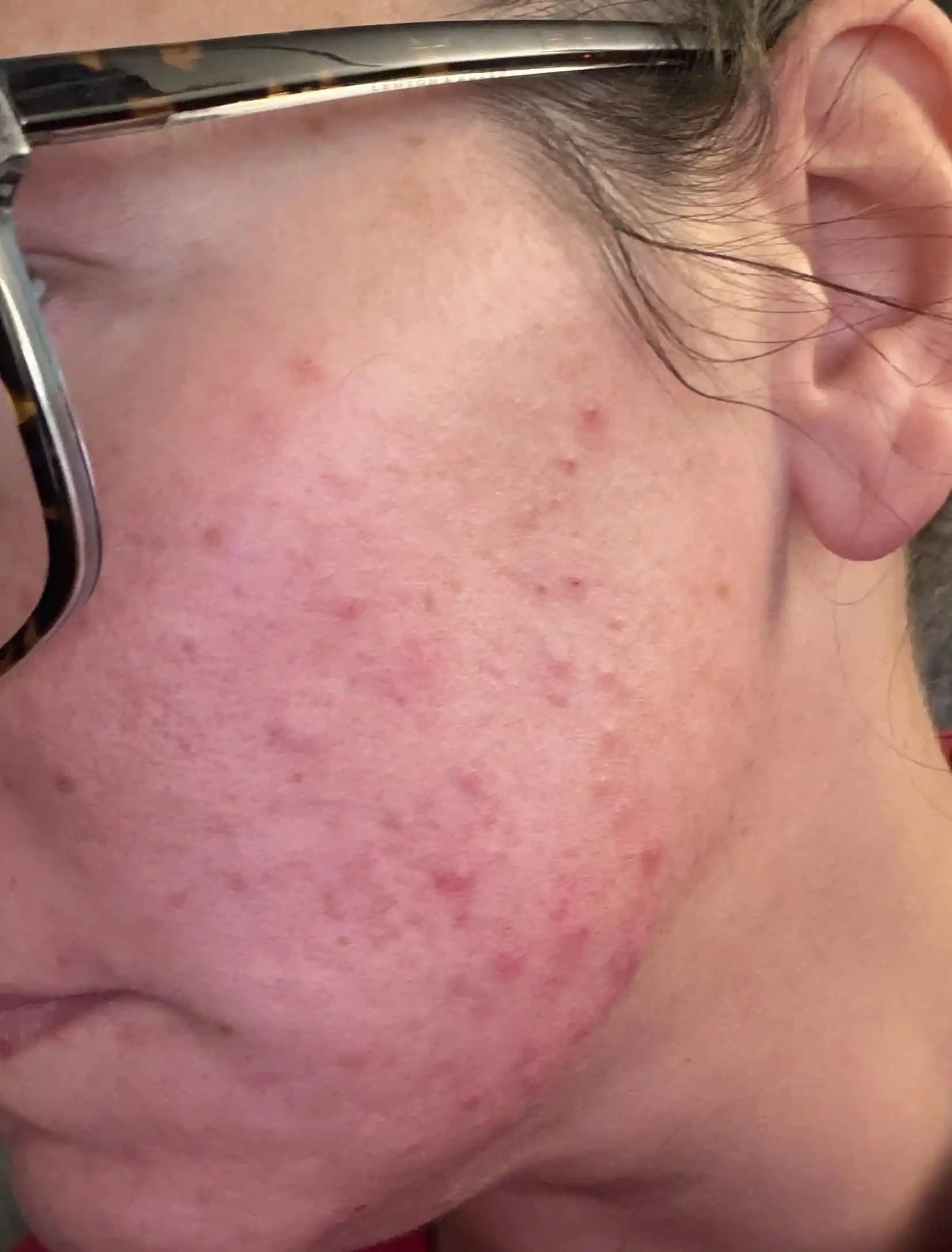 Yetişkinlerde Akne Nedenleri, Tedavi Yöntemleri ve Dikkat Edilmesi Gerekenler