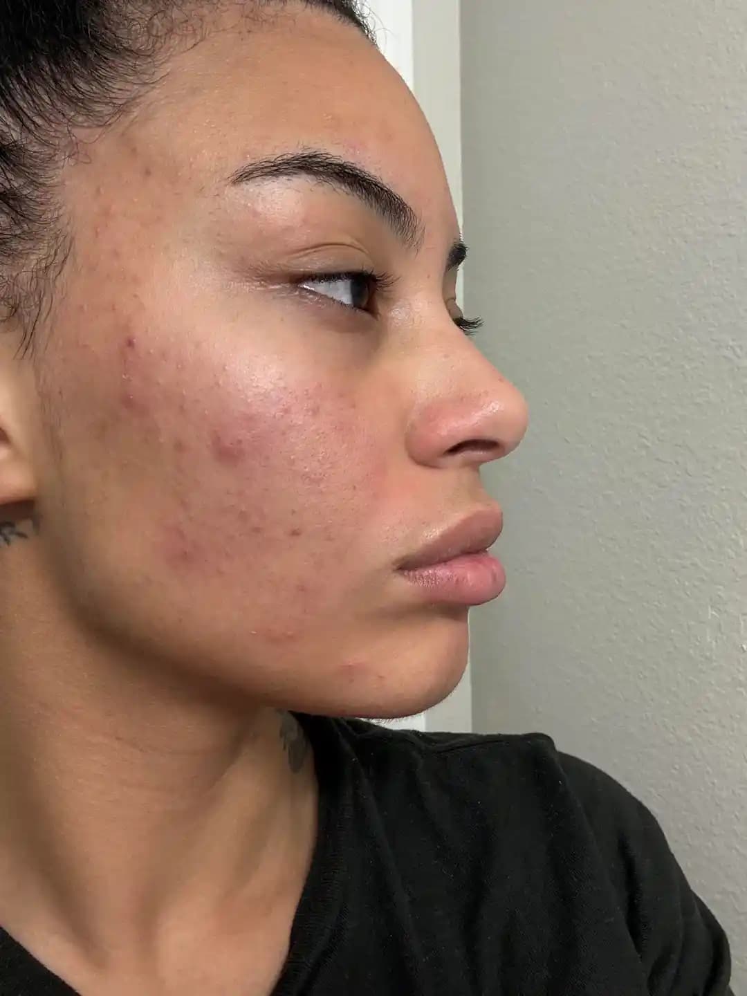 Yüzde Akne ve İzlerin Nedenleri ile Etkili Tedavi Yöntemleri ve Cilt Bakımı