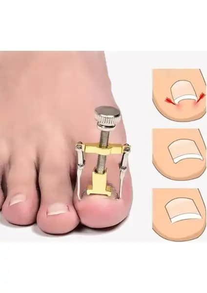 Greathings Profesyonel Batık Tırnak Düzeltme Aparatıyla Ayak Sağlığınızı Koruyun