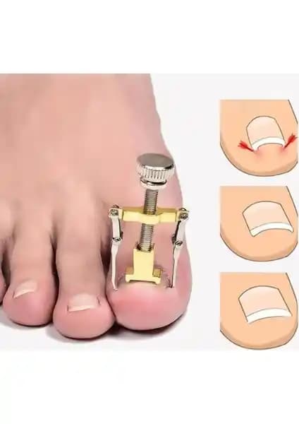 Greathings Profesyonel Batık Tırnak Düzeltme Aparatıyla Ayak Sağlığınızı Koruyun