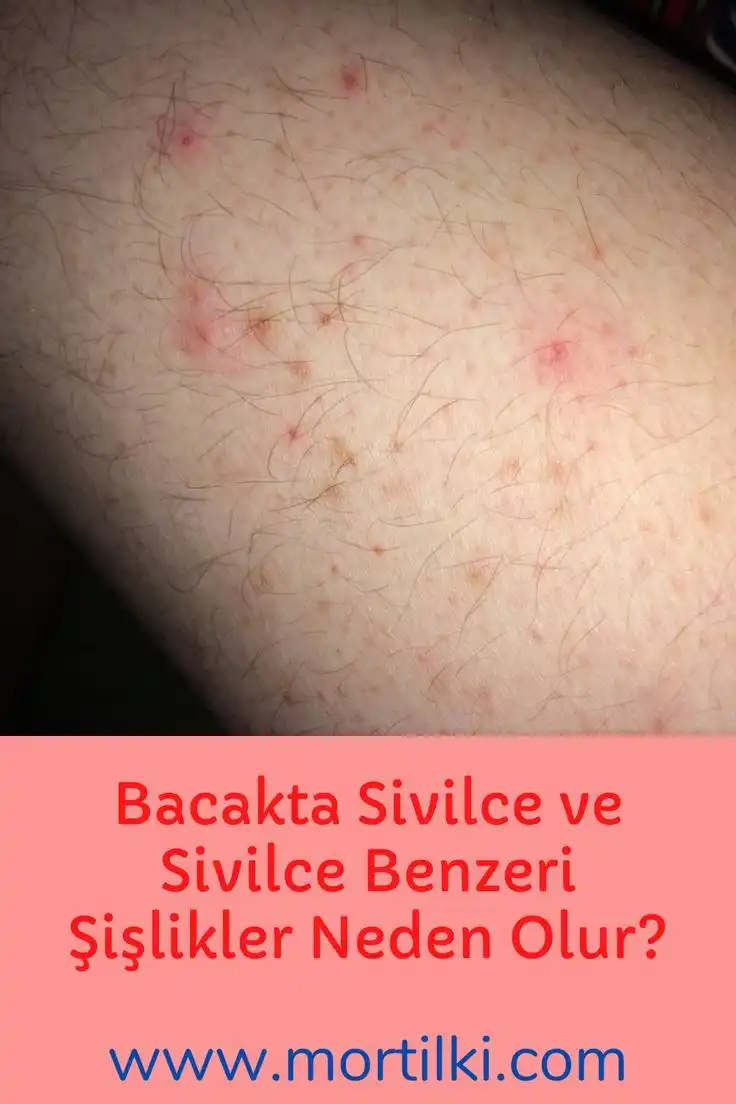 Bacak Arasında Sivilce Nedenleri ve Etkili Çözüm Yolları