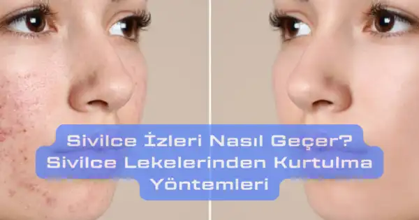 Bacaklardaki Sivilce İzleri Nasıl Geçer ve En Etkili Çözüm Yöntemleri Nelerdir?