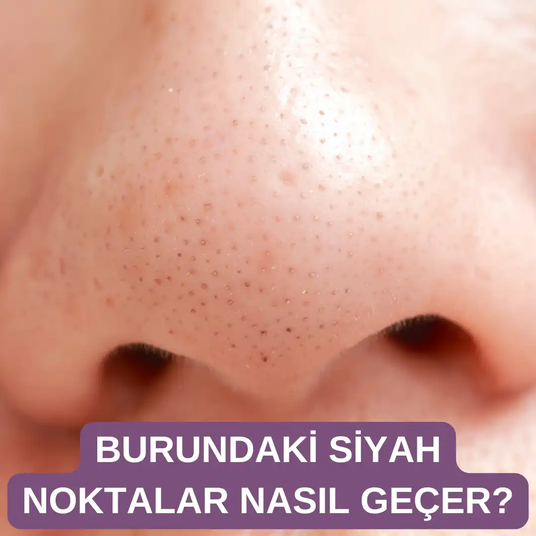 Burundaki Siyah Noktalar Nasıl Geçer Evde Uygulanabilir Etkili Yöntemler ve İpuçları