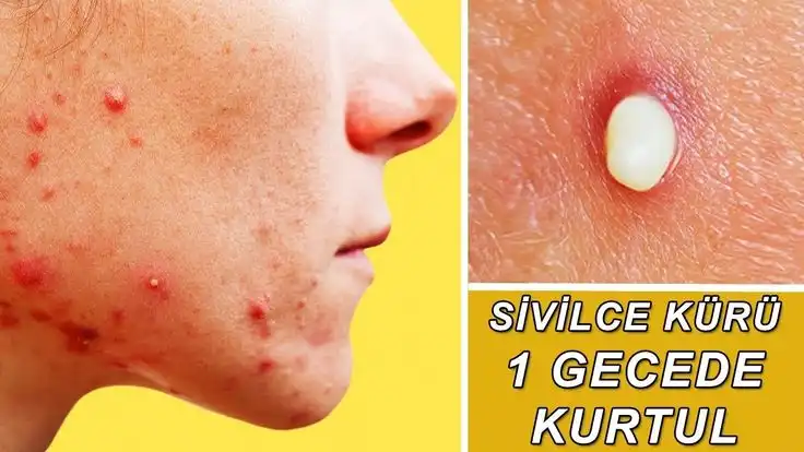 Ciltte Sivilceler: Nedenleri, Etkileri ve Etkili Çözüm Yolları Hakkında Kapsamlı Bilgi