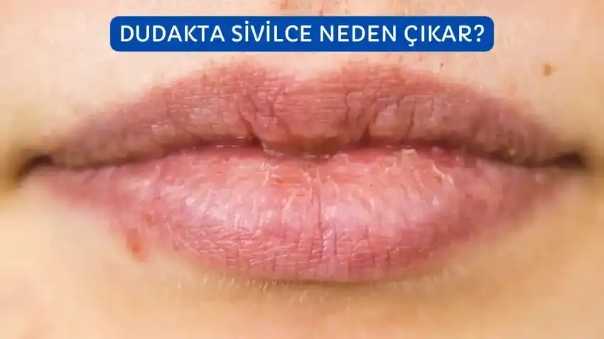 Dudak Kenarında Siyah Nokta Nedenleri, Çözüm Yolları ve Bakım İpuçları