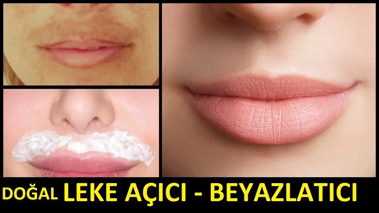 Dudak Üstü Kararması Nedenleri ve Etkili Tedavi Yöntemleri Hakkında Kapsamlı Rehber