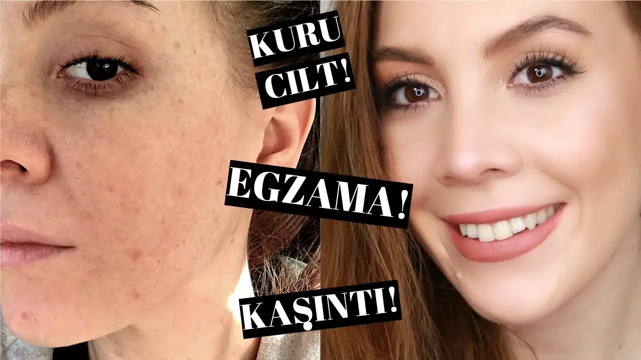 Egzama Atağı ve Kozmetik Ürünlerle Cilt Bakımında Dikkat Edilmesi Gerekenler
