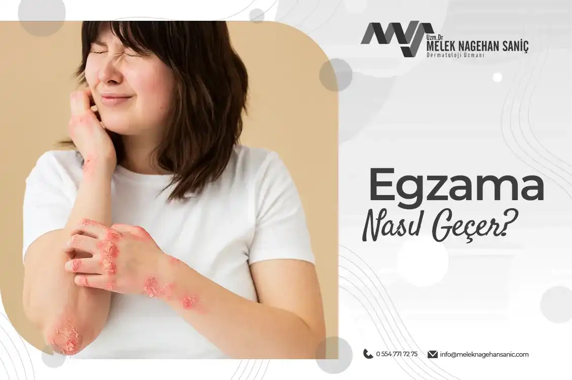 Egzama Lekeleri Nasıl Geçer: Belirtiler, Nedenler ve Etkili Tedavi Yöntemleri