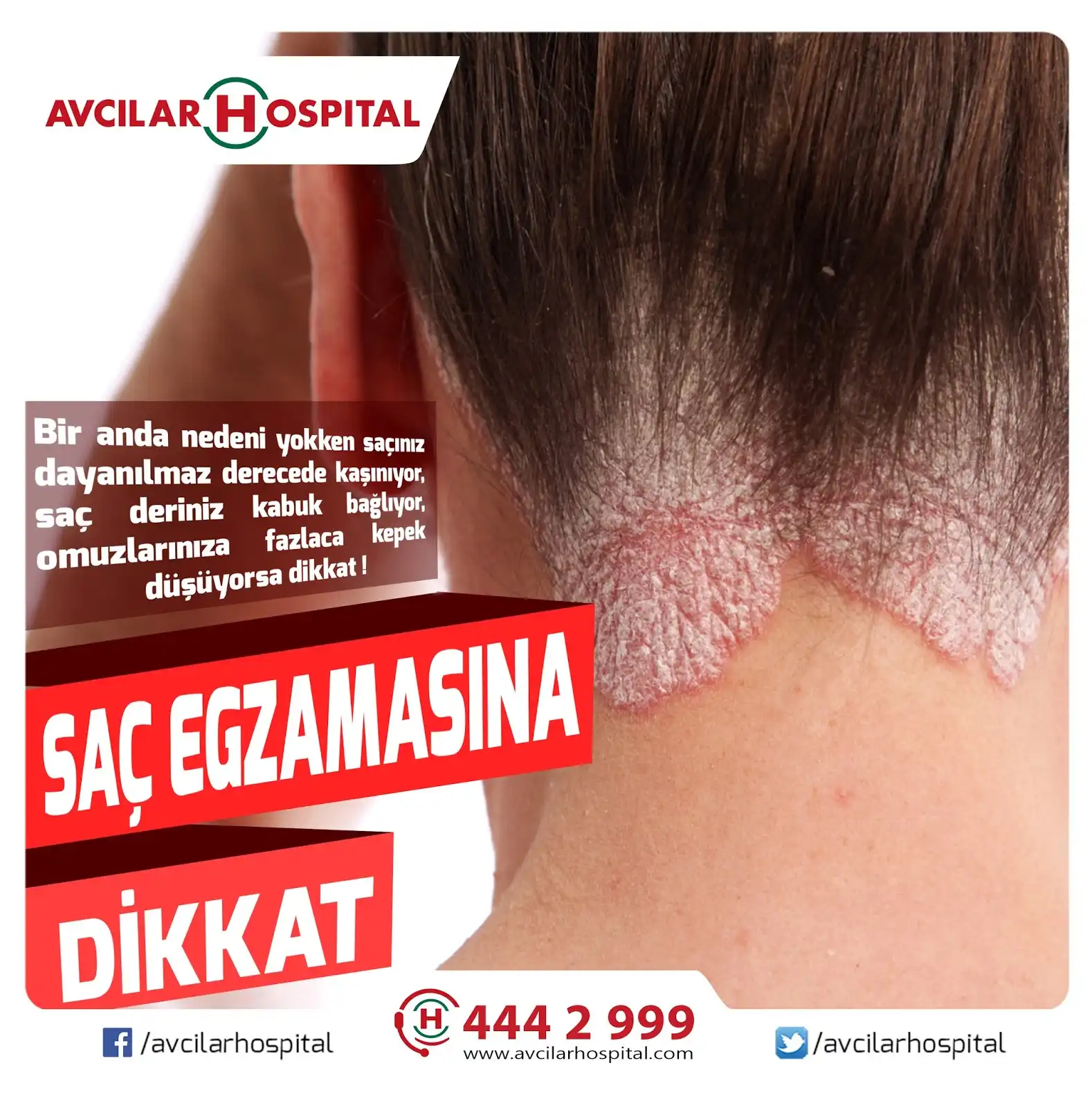 Egzamalı Saç Nedir, Belirtileri ve Doğru Bakım Yöntemleri Hakkında Kapsamlı Bilgi