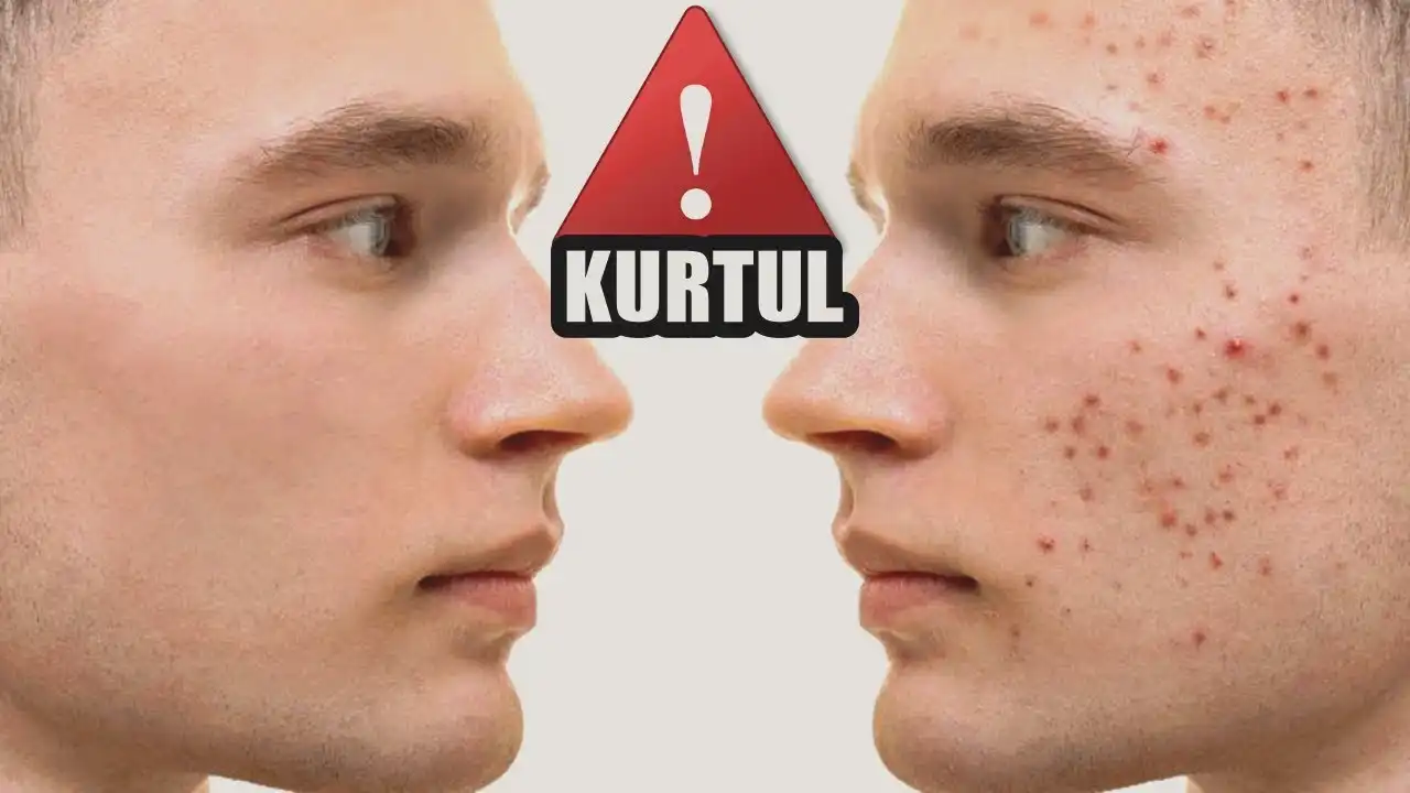 Erkeklerde Sivilce Ne Zaman Biter ve Cilt Sağlığını Koruma Yöntemleri