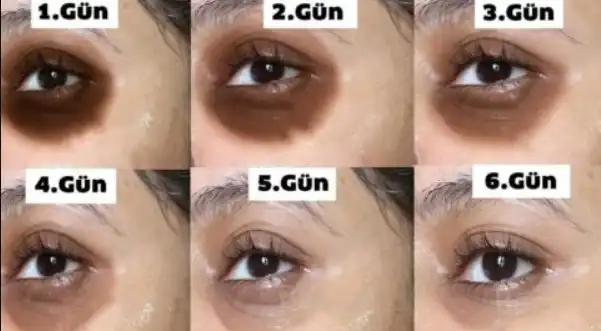 Göz Altı Morarması ve Vitamin Eksiklikleri: Sağlıklı Gözler İçin Bilmeniz Gerekenler
