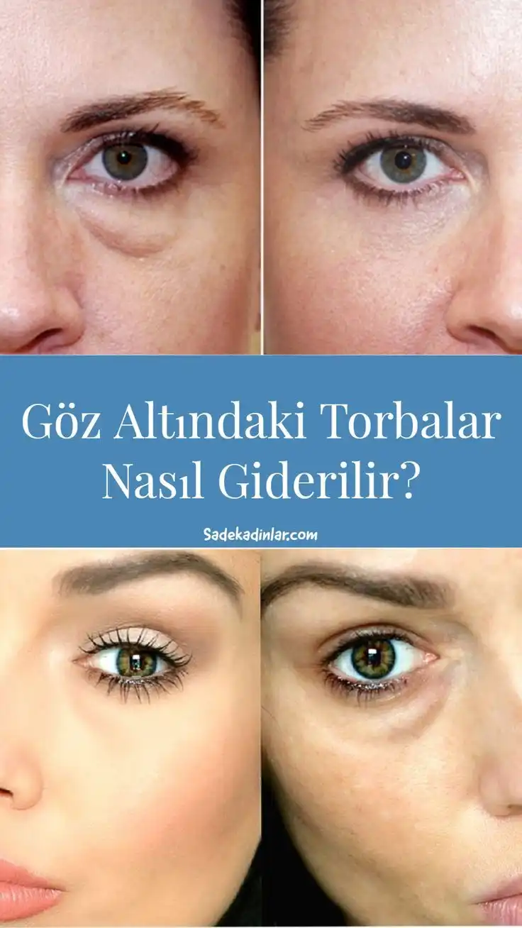 Göz Altı Morluklarının Nedenleri ve Etkili Çözüm Yöntemleri Hakkında Kapsamlı Bilgi