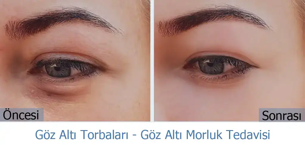 Göz Altı Torbalarıyla Mücadelede Güncel ve Etkili Yöntemler