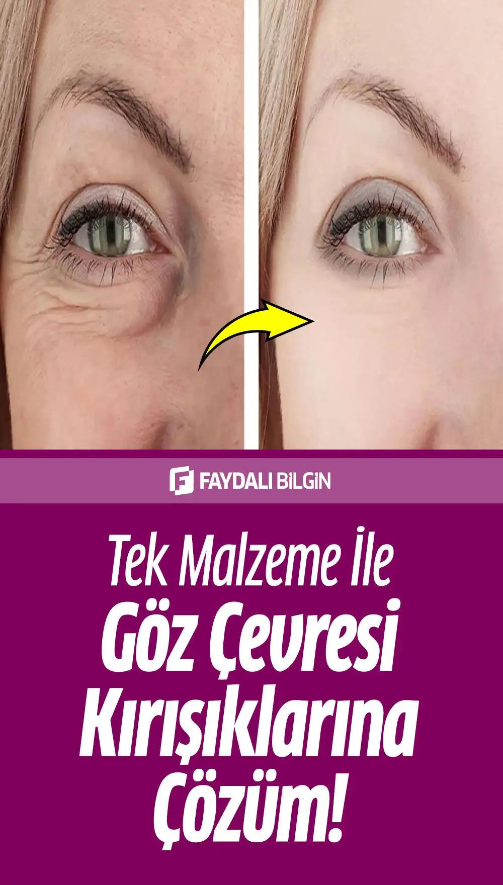 Göz Çevresi Kırışıklıklarını Önleme ve Azaltma Yöntemleri Hakkında Kapsamlı Bilgi