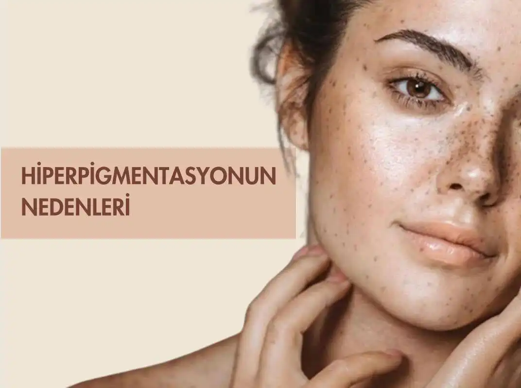 Hiperpigmentasyon Nedir ve Ciltteki Renk Değişiklikleri İçin Etkili Çözüm Yolları