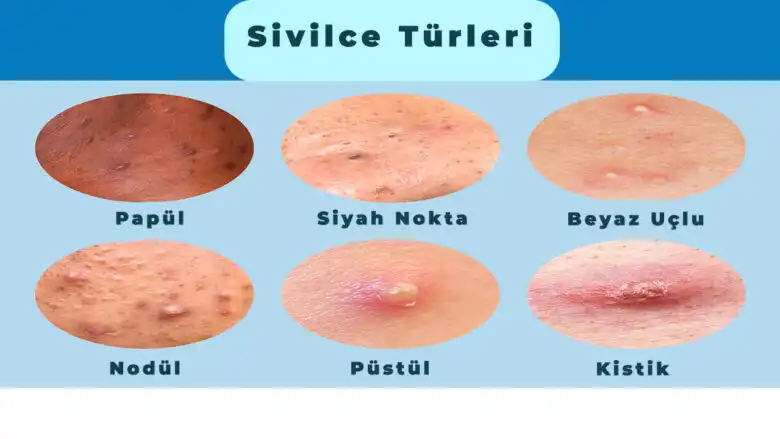 İçi Siyah Sivilce Nedir, Nedenleri ve Etkili Mücadele Yöntemleri