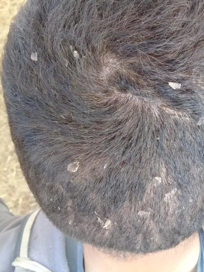 Kafada Deri Soyulmasının Nedenleri ve Etkili Koruma Yöntemleri