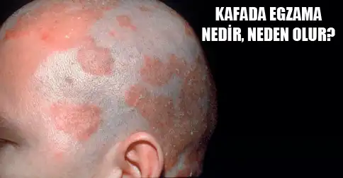 Kafada Egzema Sorunu ve Doğal Bakım Yöntemleri Hakkında Bilgilendirici Rehber