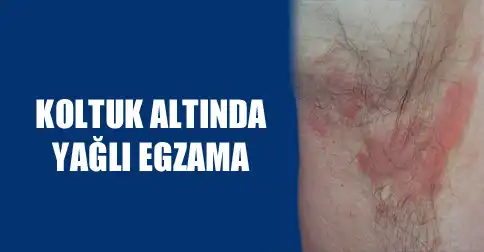 Koltuk Altı Egzaması Belirtileri ve Etkili Yönetim Yöntemleri Hakkında Kapsamlı Rehber