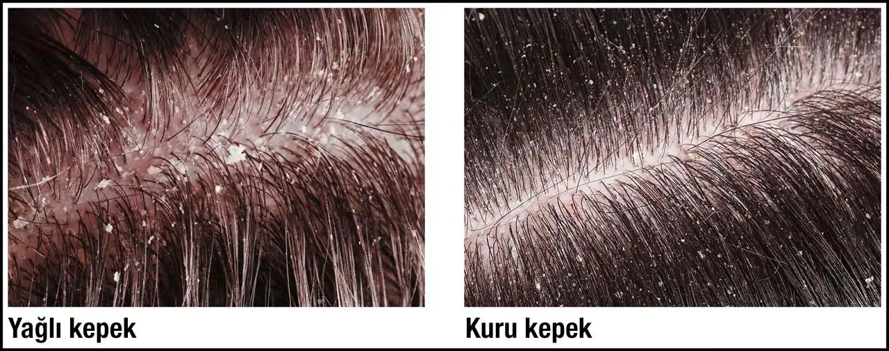 Kuru Kepek Nedenleri ve Etkili Çözüm Yöntemleri Rehberi
