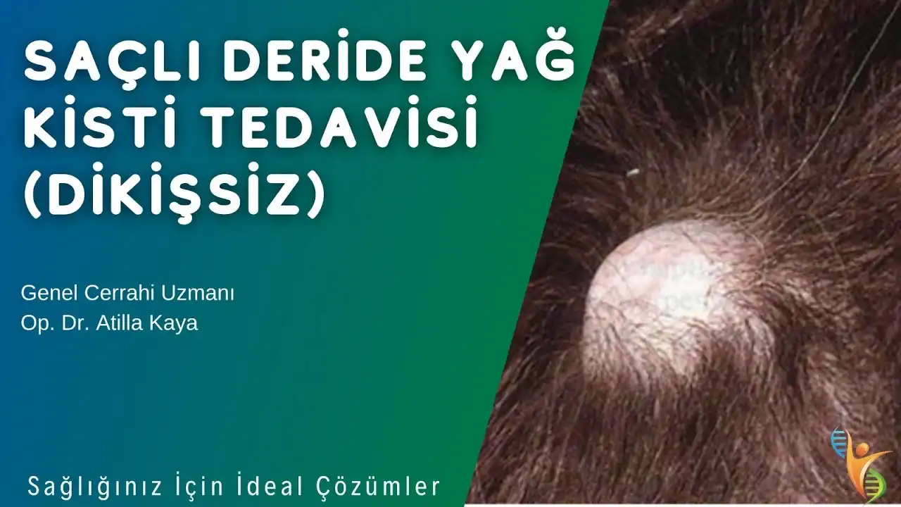 Saç Derisinde Yağ Bezesi Nedir, Belirtileri ve Etkili Tedavi Yöntemleri
