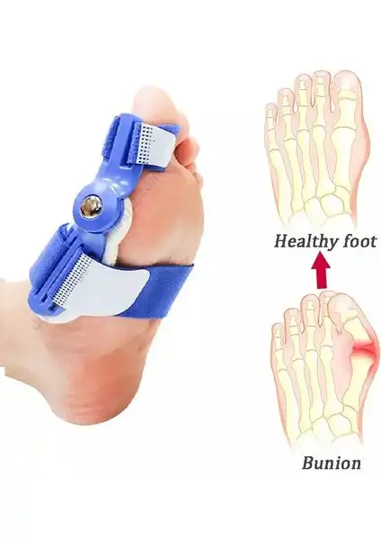 Silimo Gece Ateli ile Hallux Valgus Sorununu Hafifletme ve Düzeltme Çözümü